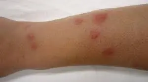 Bed bug bite